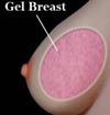 Gel Breasts